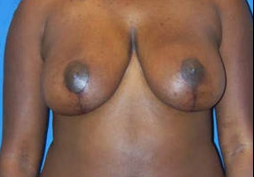 after breast reduction front view case 11
