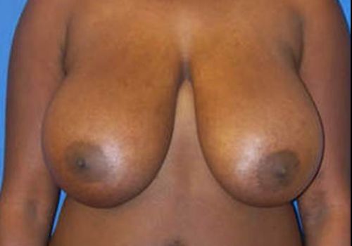 before breast reduction front view case 11
