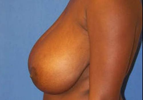 before breast reduction side view case 2042