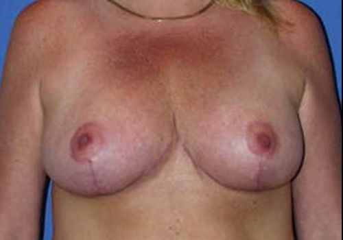 after breast reduction front view case 2046