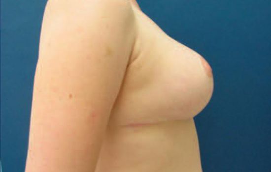 after breast lift right side view case 2883