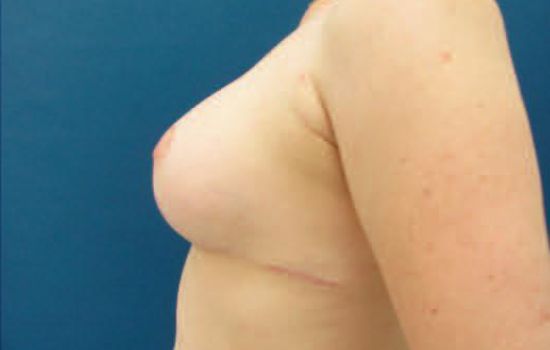after breast lift left side view case 2883