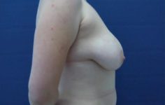 before breast lift right side view case 2883