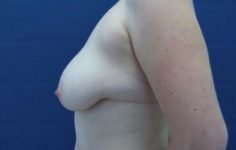 before breast lift left side view case 2883